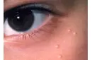 Göz Altındaki Yağ Bezeleri Belirtileri ve Tedavisi