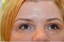 Alında Yağ Bezesi Belirtileri ve Tedavisi