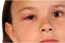 Çocuklarda Yağ Bezesi Belirtileri ve Tedavisi