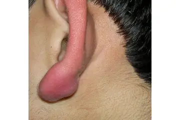 Kulak Memesinde Yağ Bezesi Belirtileri ve Tedavisi